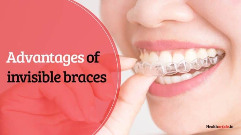advantages of invisible braces